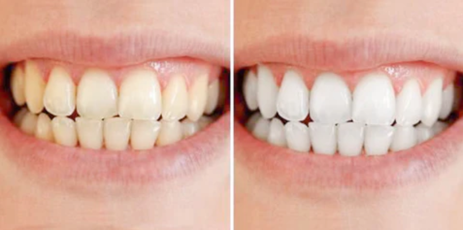 Tannbleking penn - klinisk inspirert bleking hjemme