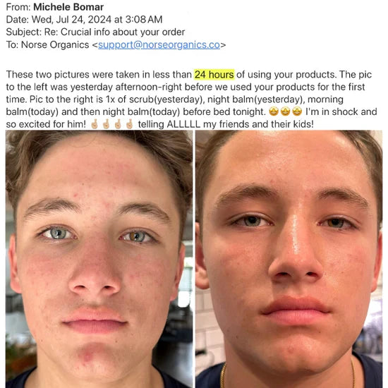 Aknedrepende sett – Effektiv mot kviser, rødhet & Porer