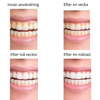 GlowSmile™ – Ultraljudsrengöring