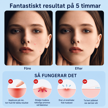 Akneplaster – lad huden komme sig i fred