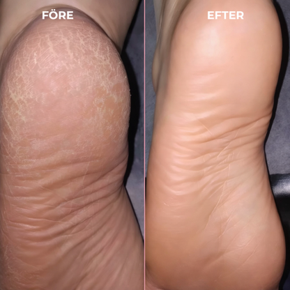 SmoothHeel™ Elektrisk fodfil og neglefil 2-i-1