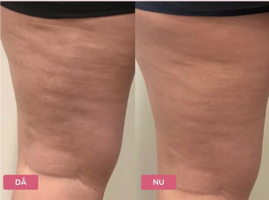 Elektrisk Koppningsmassage™